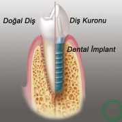 dentalimplant2