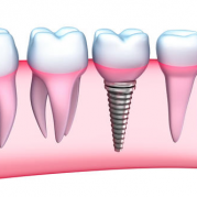 implant-dis-nedir