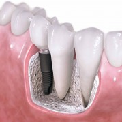implant-nedir