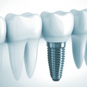 implant-tedavisi