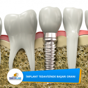 implantbaşarıoranı